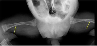 Are we undertreating calcium deficiency in metabolic bone disease of prematurity? A case report and review